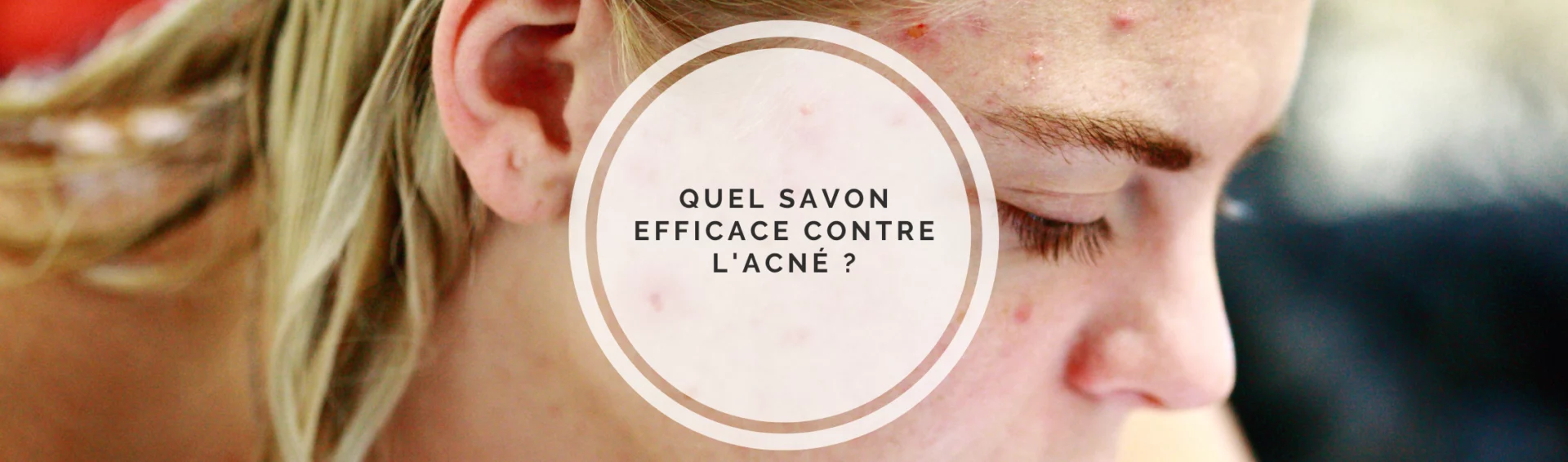Quel savon efficace contre l'acné ?